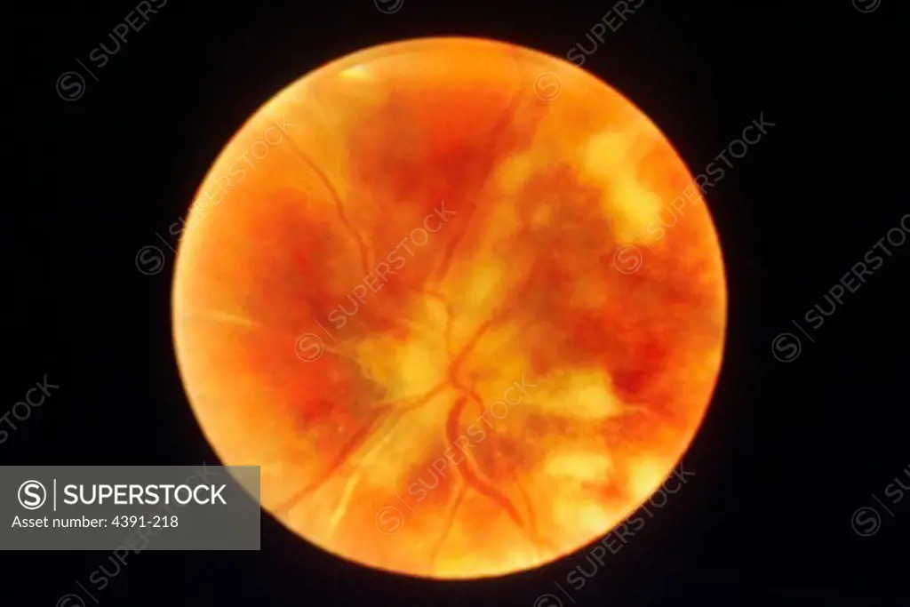 A photograph of the back of the eye, or retina, of an AIDS patient with chorioretinitis, which is an inflammation of the retina and choroid (thin pigmented vascular coat of the eye).