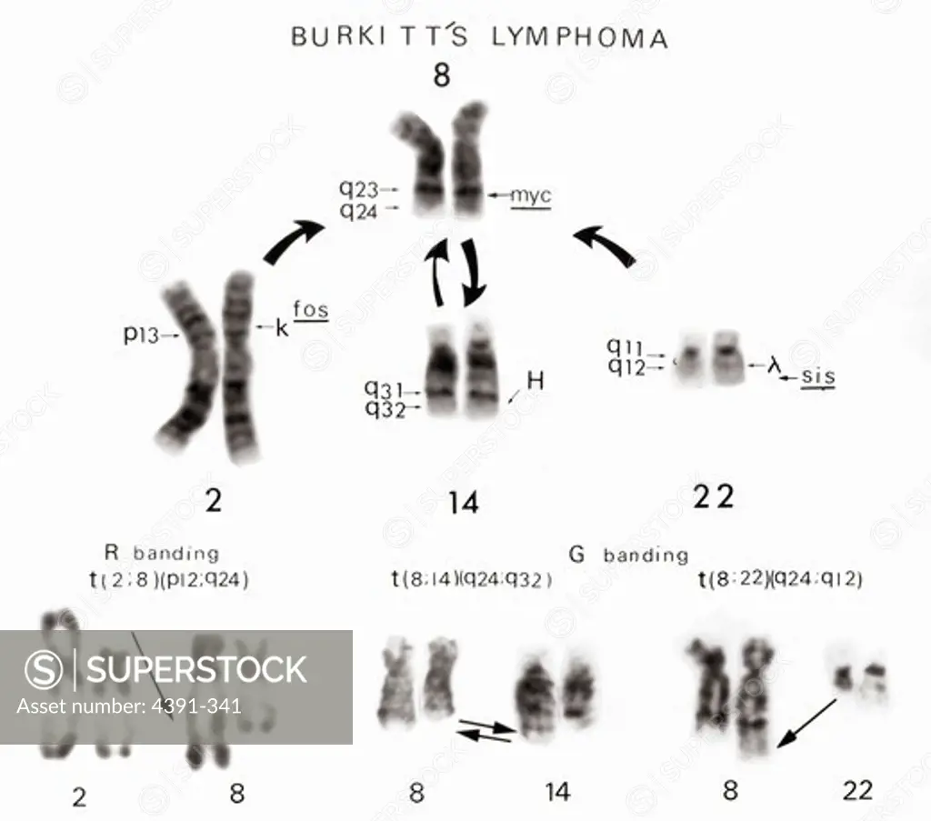 A partial karyotype showing translocations involving Chromosome 8 and Chromosomes 2, 14, and 22 in Burkitt's lymphoma, a type of cancer. The cellular oncogenes myc, fos, and sis have been mapped to the chromosomal sites indicated. H, k, and x indicate the location of genes for the heavy and light chain immunoglobulins.