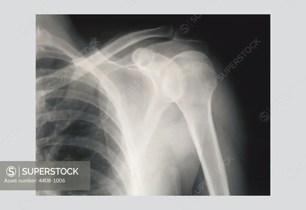 Shoulder, Medical - Xray / Radiology