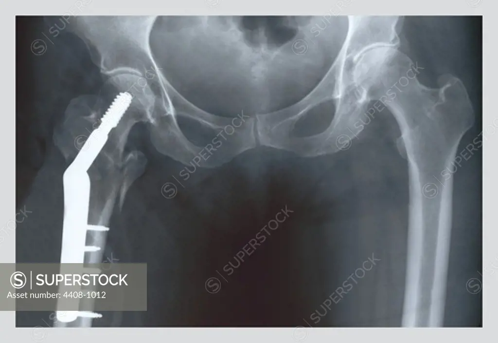 Femur Repair, Medical - Xray / Radiology