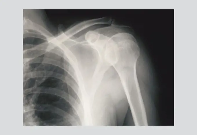 Shoulder, Medical - Xray / Radiology