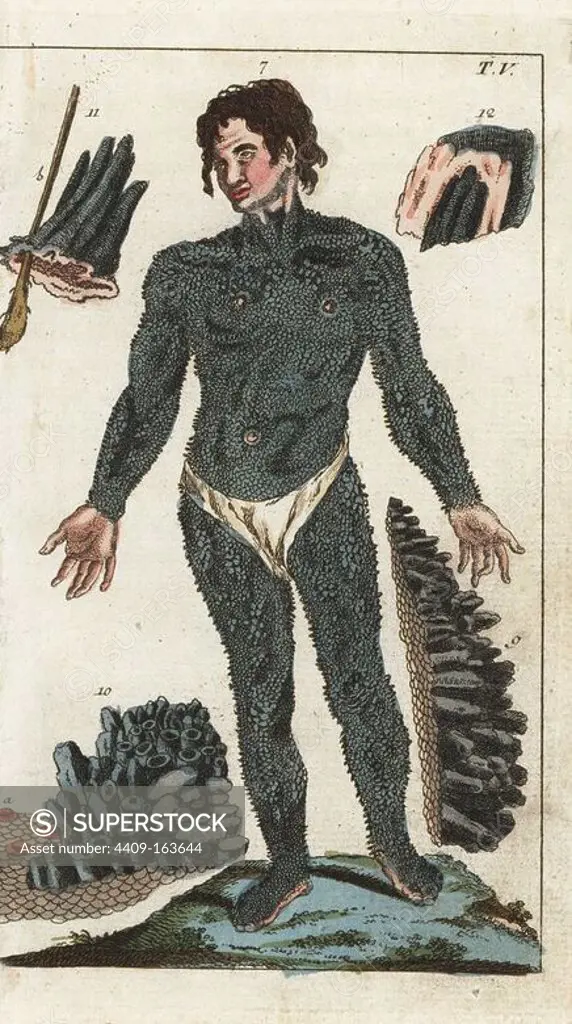 Englishman John Lambert (22) exhibited his porcupine skin disorder, Ichthyosis hystrix, in Leipzig. John was a descendent of Edward Lambert, whose condition was first described by Machin in 1732. Handcolored copperplate engraving from G. T. Wilhelm's "Encyclopedia of Natural History: Mankind," Augsburg, 1804. Gottlieb Tobias Wilhelm (1758-1811) was a Bavarian clergyman and naturalist known as the German Buffon.