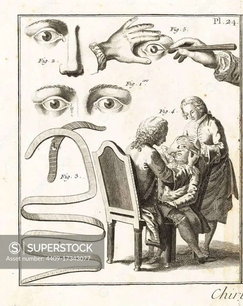 Lacrimal gland conditions 1,2, bandages for lacrimal gland swelling 3, and cataract surgery 4,5, 18th century. Copperplate engraving by Robert Benard from Denis Diderot's Encyclopedia, Pellet, Geneva, 1779.