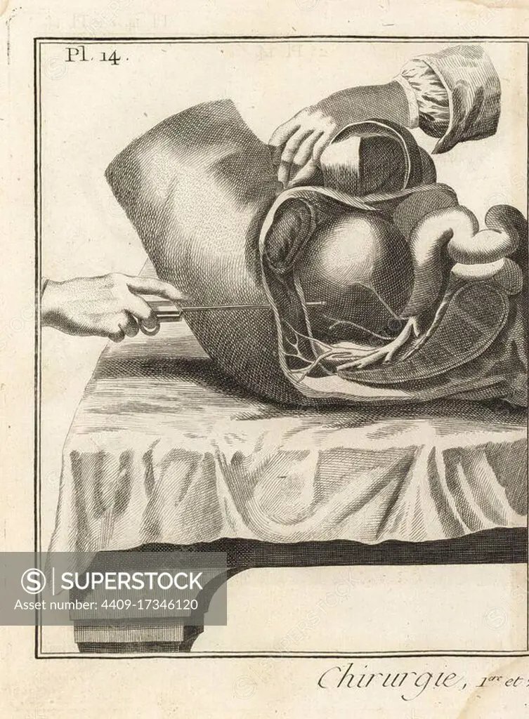 Foubert's surgical operation to remove a bladder stone. Lateral incision in the hypogastrium, showing the direction of the trocar in the bladder. Copperplate engraving by Robert Benard from Denis Diderot's Encyclopedia, Pellet, Geneva, 1779.