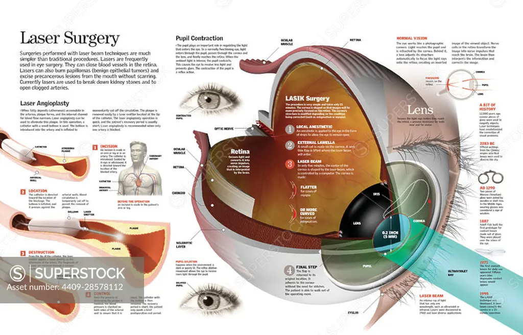 Infographic of an angioplasty and ocular surgery (or eye surgery) by means of laser rays. QuarkXPress (.qxp); 5000x3208.