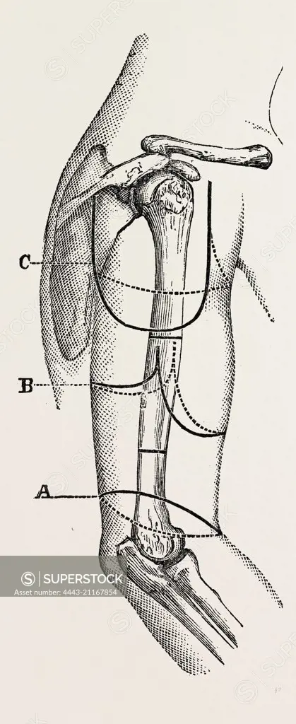 circular (inclined) amputation, medical equipment, surgical instrument, history of medicine