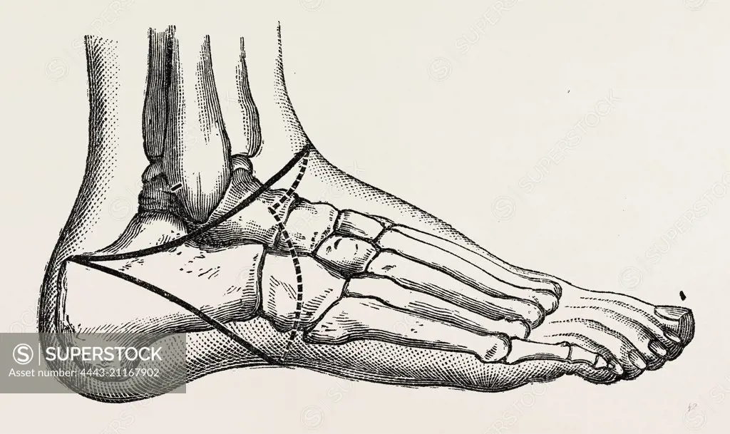 roux's amputation, medical equipment, surgical instrument, history of medicine