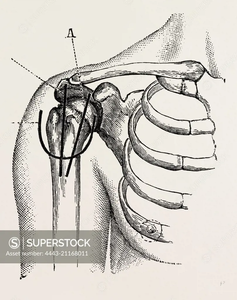 excision of the shoulder, medical equipment, surgical instrument, history of medicine