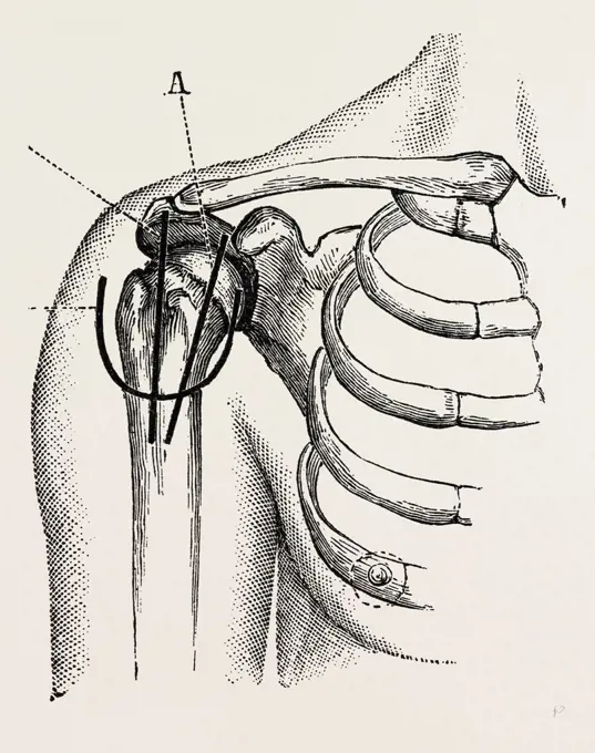 excision of the shoulder, medical equipment, surgical instrument, history of medicine