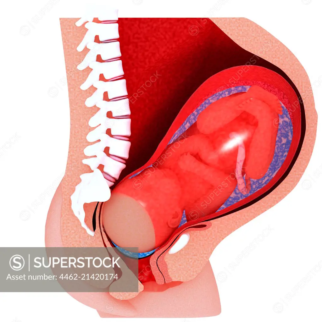 Cross section of womb with foetus being expelled from amniotic sac