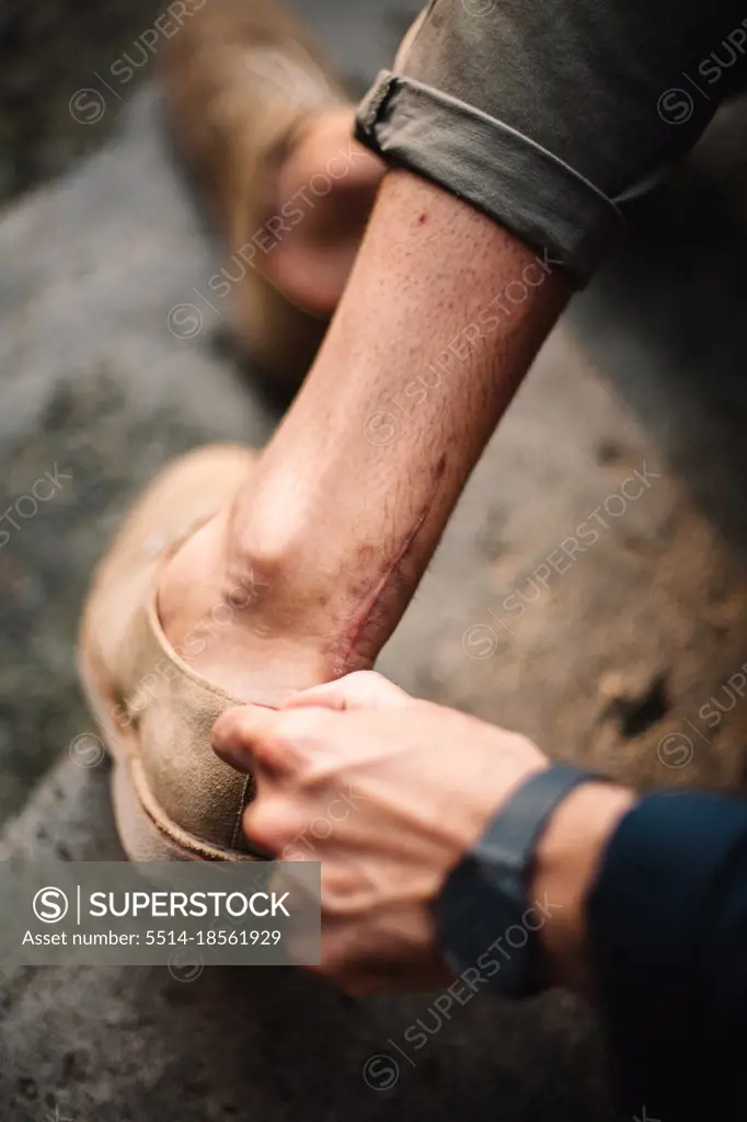 Man showing surgical scar from achilles tendon injury on his leg