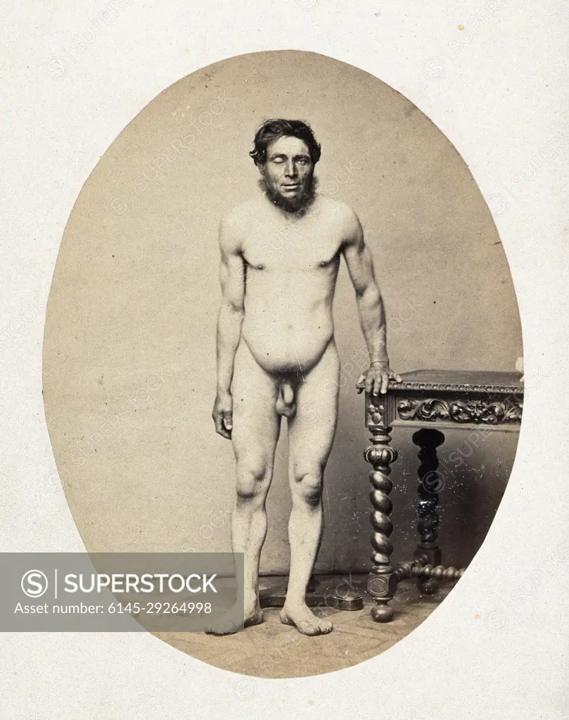 A naked man, standing, viewed in full length from the front; he is leaning  on a table and his right eye is closed. Photograph by L. Haase after H.W.  Berend, c. 1865. -