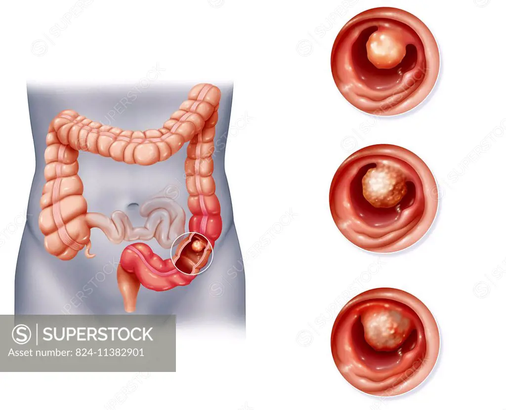 Illustration of colon cancer. the cancer develops on the colons mucus membrane. in 70% of cases, the tumour develops in the sigmoid colon. developmen...