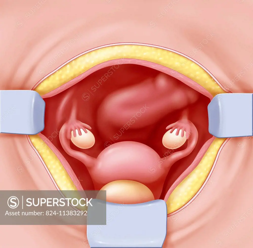 Illustration of a hysterectomy through the abdomen, with a low suprapubic median abdominal incision, known as the pfannenstiel incision.