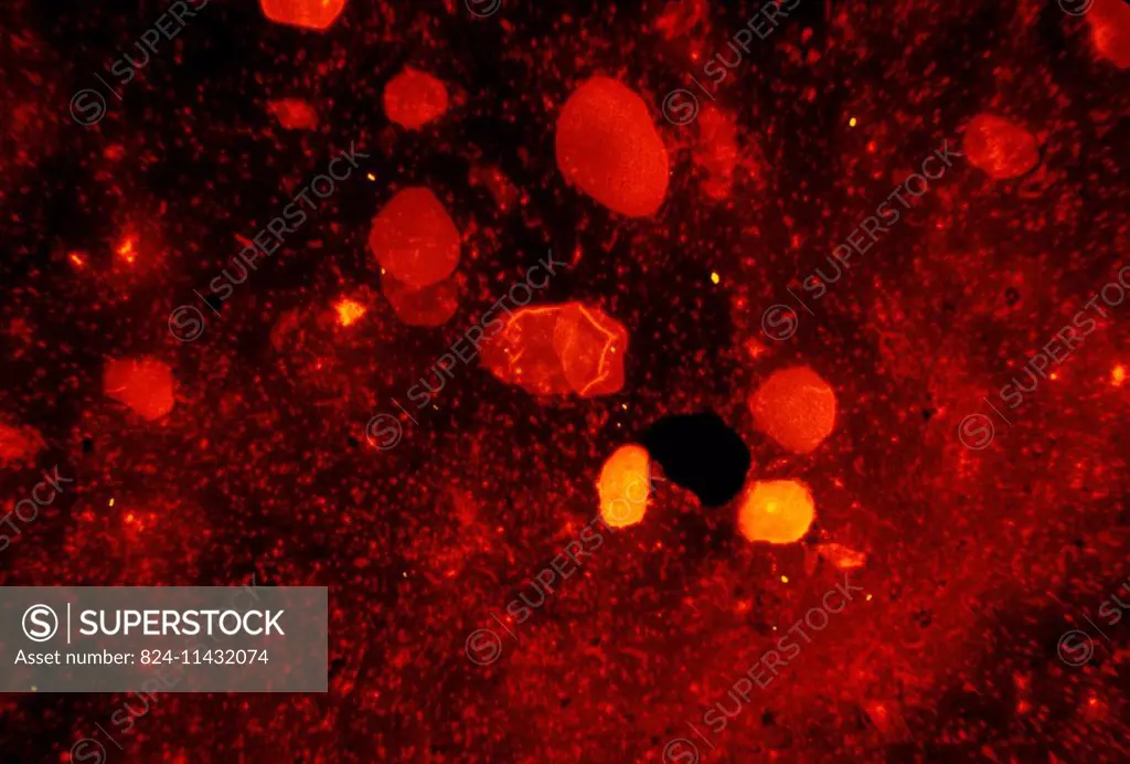 Here we see Mycobacterium tuberculosis in a sputum smear is stained using fluorescent acid-fast stain. M. tuberculosis is an acid-fast bacterium (AFB)...