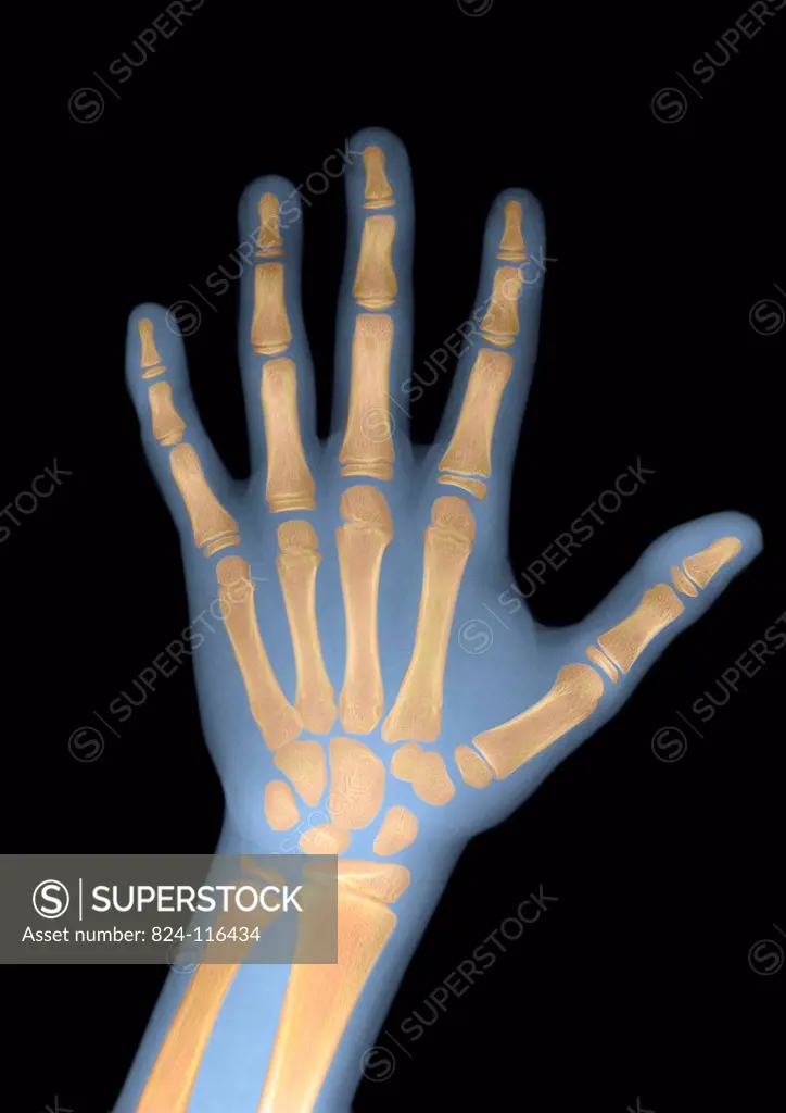 Calculation of the bone age with a radiography. 12 years old hand x ray. Normal size