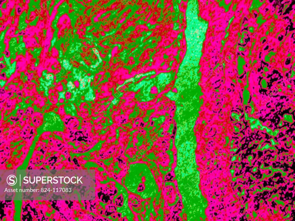 Cervical cancer. Squamous cell metaplasia seen by the microscopy of a histological section of the endocervical epithelium.