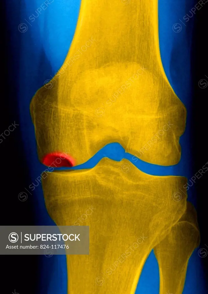 Severe osteonecrosis of the knee of a 78 years old patient. X Ray