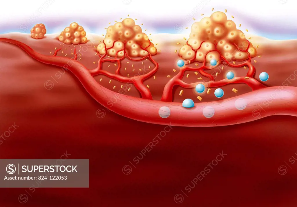 ANTI-ANGIOGENESIS, DRAWING. Illustration from left to right of angiogenesis. When a tumour forms it produces substances called VEGF (yellow) that stim...