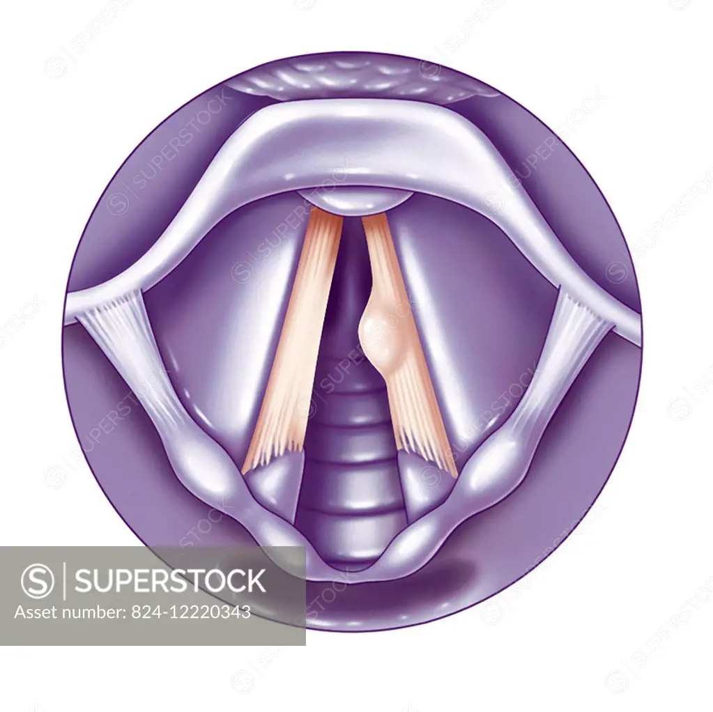 illustration of a vocal chord pathology called a cyst.