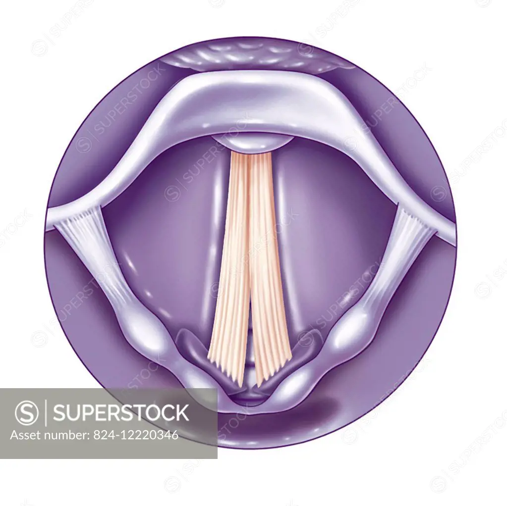 illustration of a vocal chord pathology called posterior glottal air leakage, which lets air through.