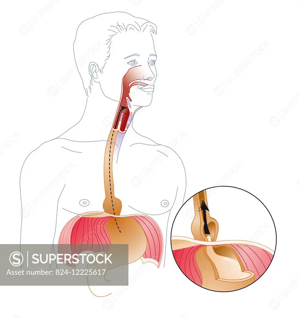 illustration of a hiatal hernia. a hiatal hernia is when part of the stomach (at the cardia) goes into the thorax through the hiatal orifice of the di...