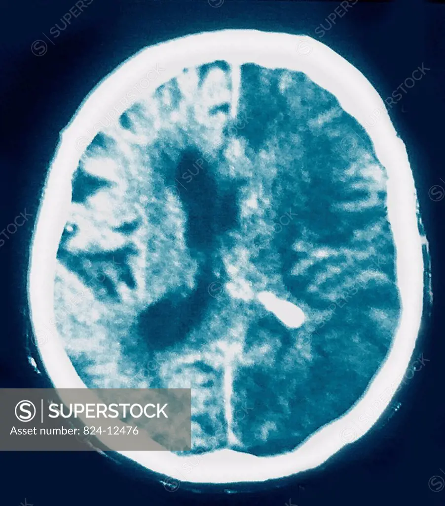 Intracerebral hemorrhage ICH, a type of stroke caused by bleeding within the brain tissue. Axial CT scan of the brain.
