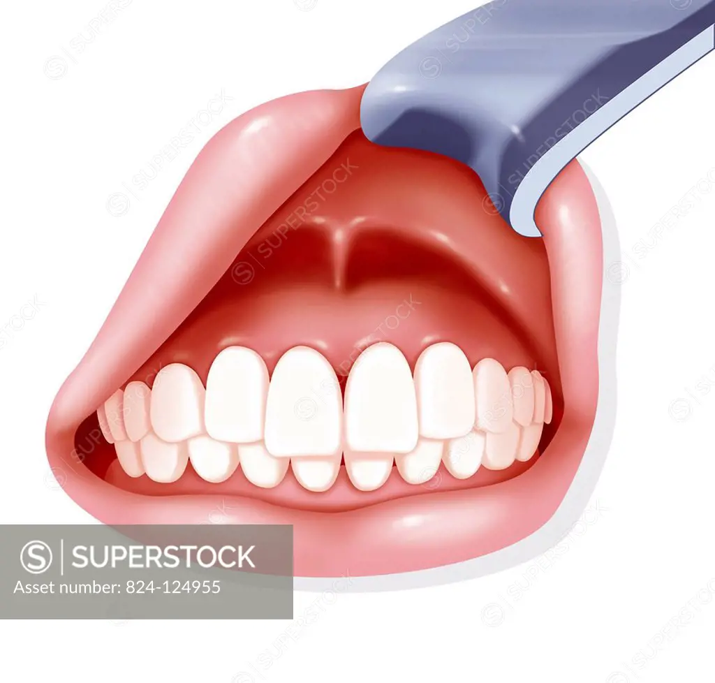 Illustration of the mouth cavity. The upper lip is raised, showing the gums and superior dental arch, the frenum is in the middle between the gum and ...