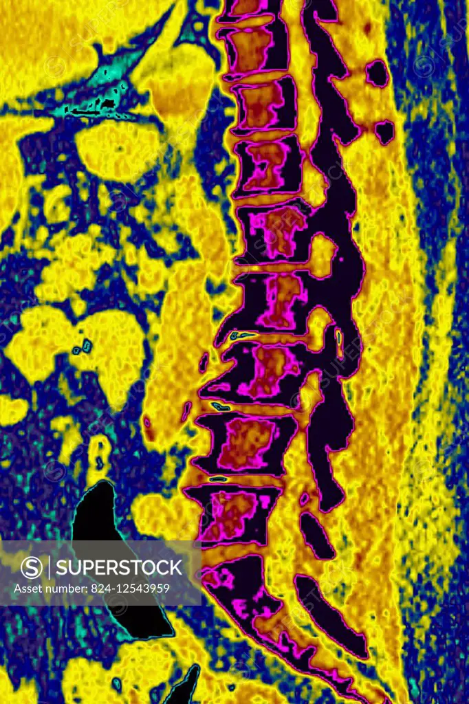 Degenerative disk disease. Severe vertebral osteoarthritis with osteoporsis and osteophytes, seen on a side lumbar x-ray.