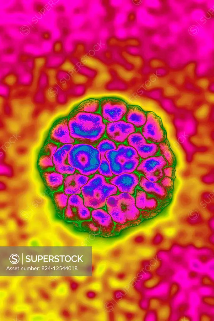 Human Papilloma virus (HPV). HPV causes STDs, condyloma acuminata warts that can lead to cervical cancer. It is also the cause of skin infections, war...