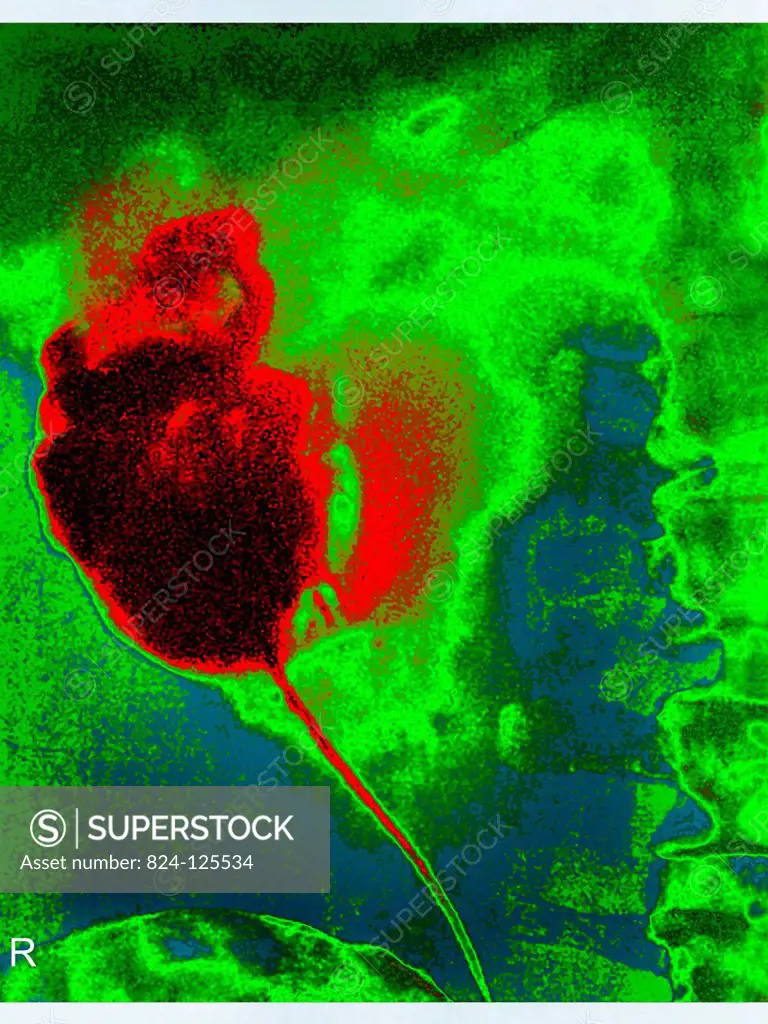 Traumatic injury of the right kidney with fissures, splitting of the renal capsule and bruising. Frontal abdominal x-ray.