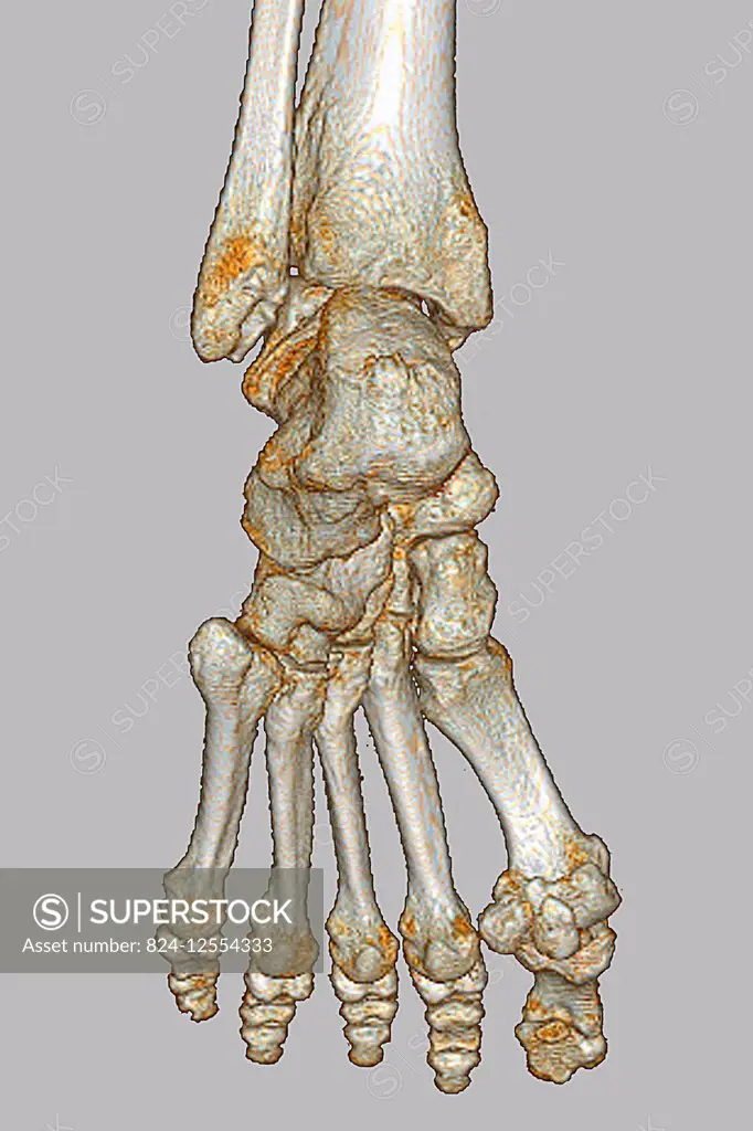 Hallux valgus on the big toe, seen on a 3D CT scan of the right foot.