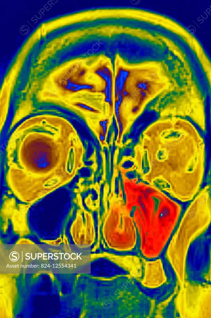 Sinusitis in the left maxillary sinus, seen on a frontal, cross-section MRI scan.