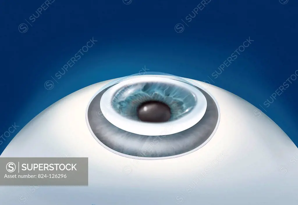 Illustration of an artificial cornea transplant. After making an incision in the cornea, the keratoprosthesis is inserted into the opaque cornea. Non-...