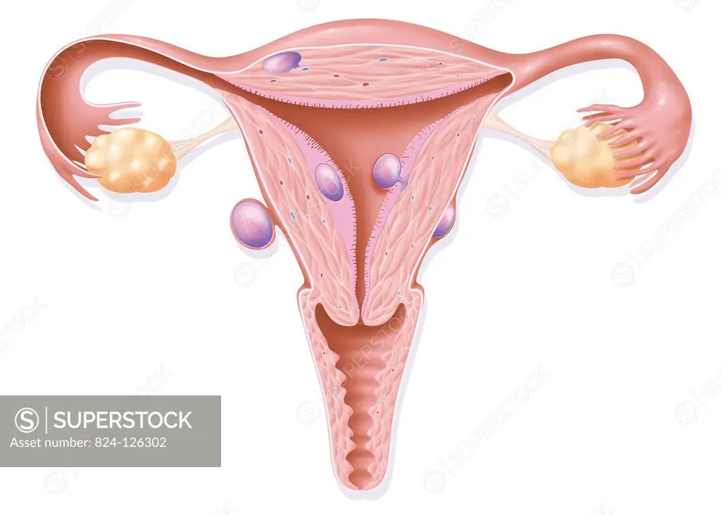 Illustration of three types of uterine fibroma. - at the top, the intramural fibroma is the most common. It forms within the wall of the uterus. - on ...