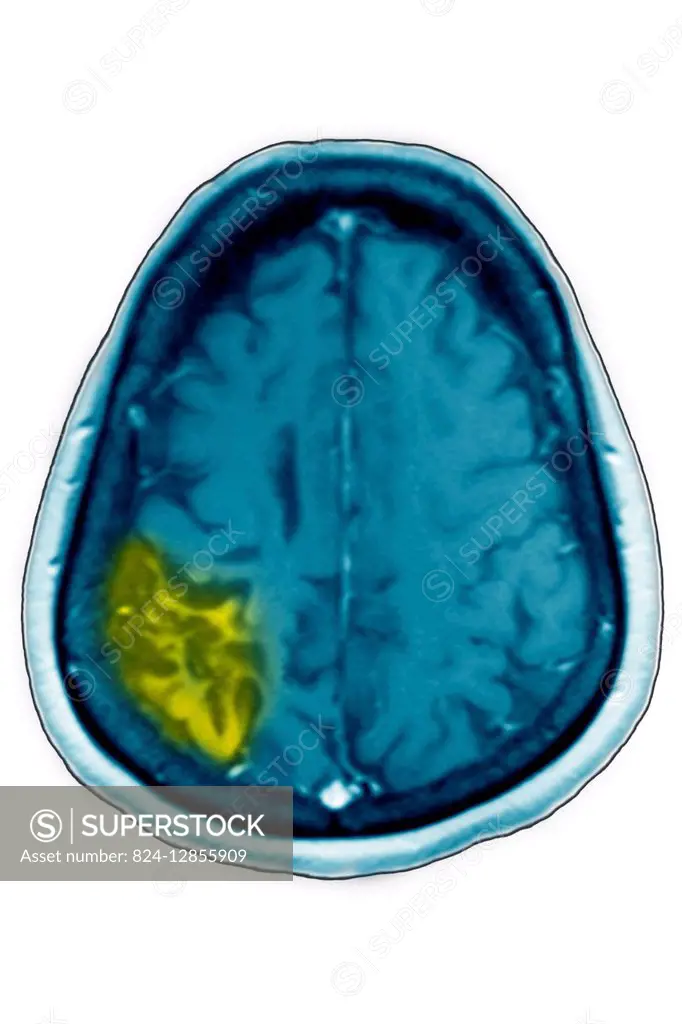 Cerebral atrophy. Cortical-sub-cortical parietal atrophy as a result of an ischemic stroke, seen in a radial section MRI.