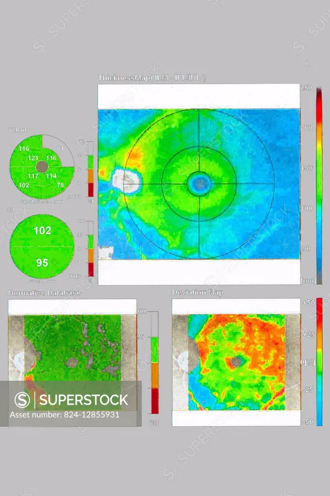 Optical Coherence Topography (OCT) image, showing a macular map. On this image, the left eye to prevent glaucoma.