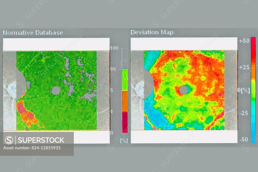 Optical Coherence Topography (OCT) image, showing a macular map. On this image, the left eye to prevent glaucoma.