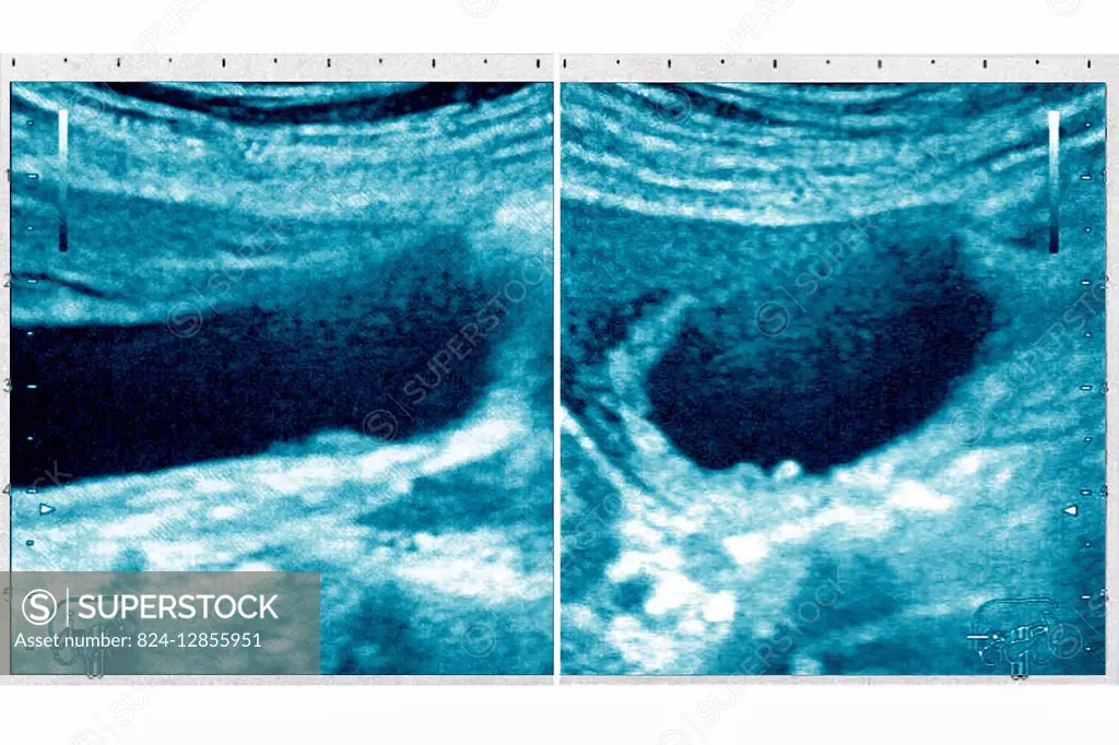 Calculus cholecystitis (microlithiasis), seen on two ultrasounds (longitudinal and transversal) of the gallbladder.