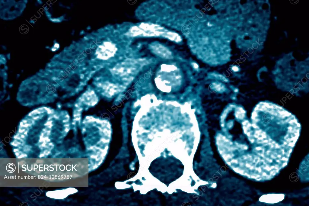 Atheromatous calcifications of the abdominal aorta and its branches. Radial section abdominal CT scan.