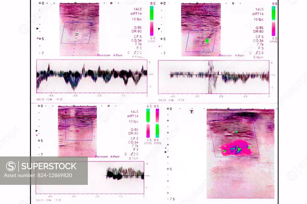 Venous doppler test in the lower limbs (observation of the after-effects post-phlebitis).