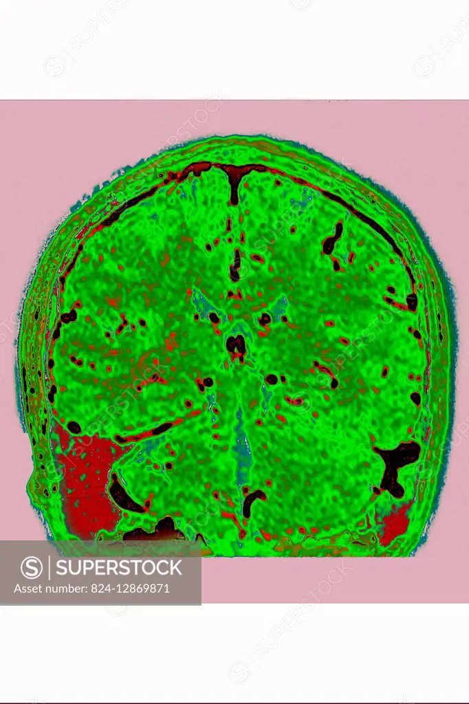 Multiple hemorrhagic foci, in contact with the meninges. Cross-section brain MRI.