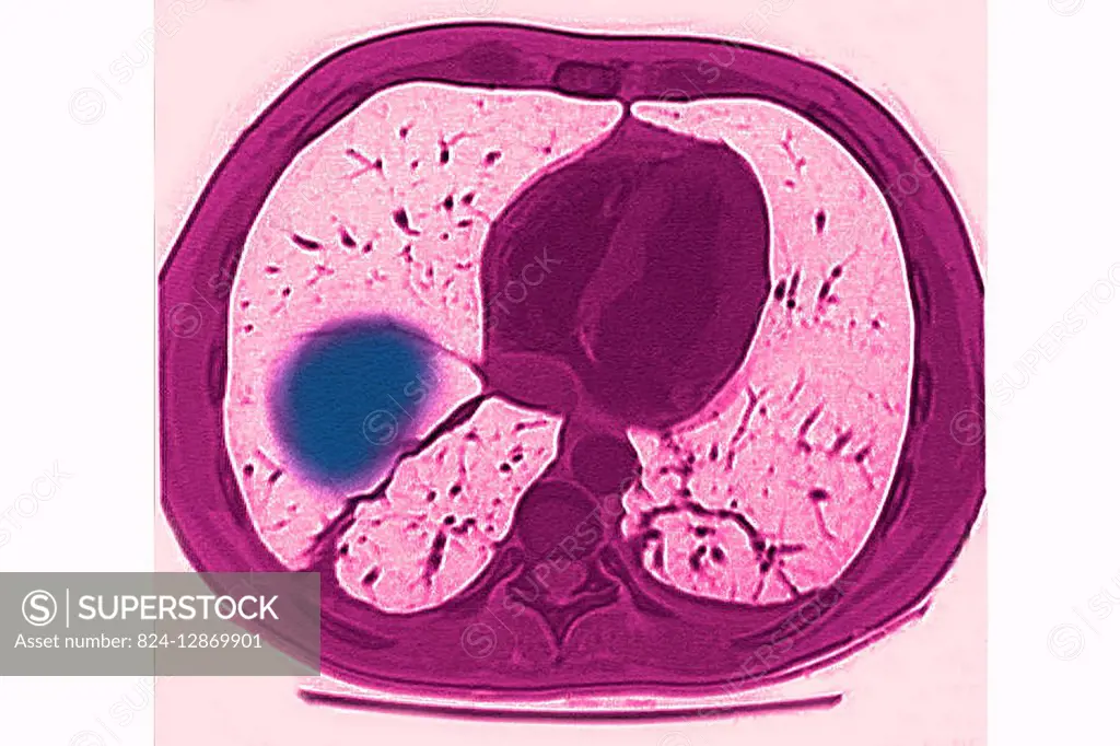 Pulmonary infarction seen on a cross-section CT scan of the chest.