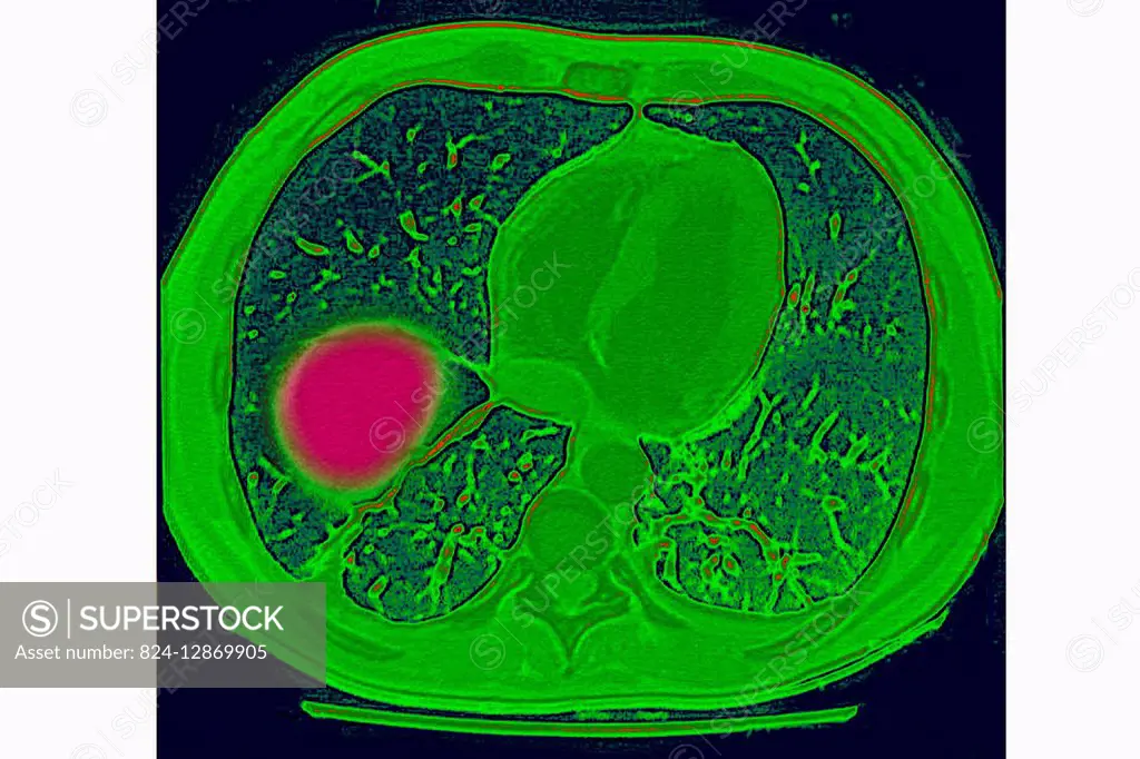 Pulmonary infarction seen on a cross-section CT scan of the chest.