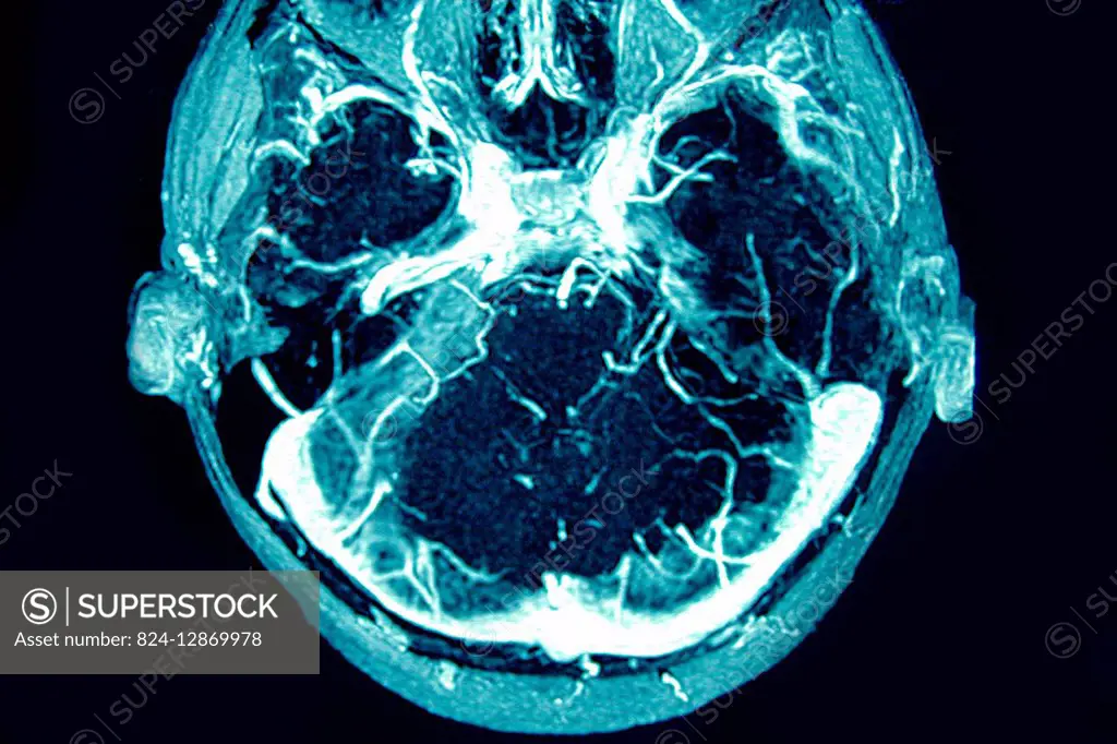 Cerebral venous thrombosis of the left transverse sinus. Radial section brain CTA scan.