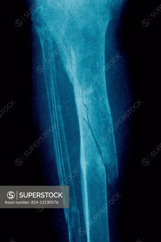 Fractures of the tibia and fibula seen on a frontal x-ray.