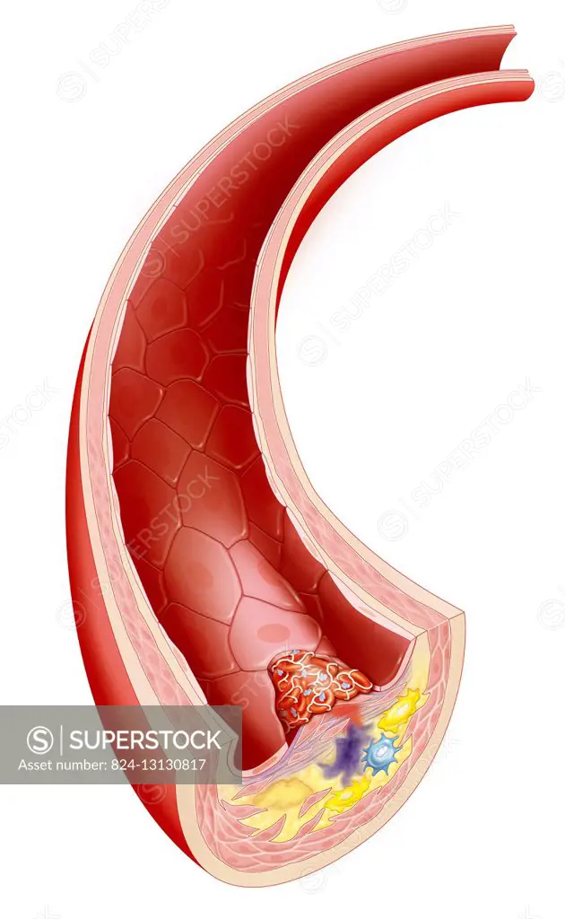 Illustration of a thrombus (clot) forming. The rupture in the atheromatous plaque has caused a platelet reaction that can lead to a blocked artery.