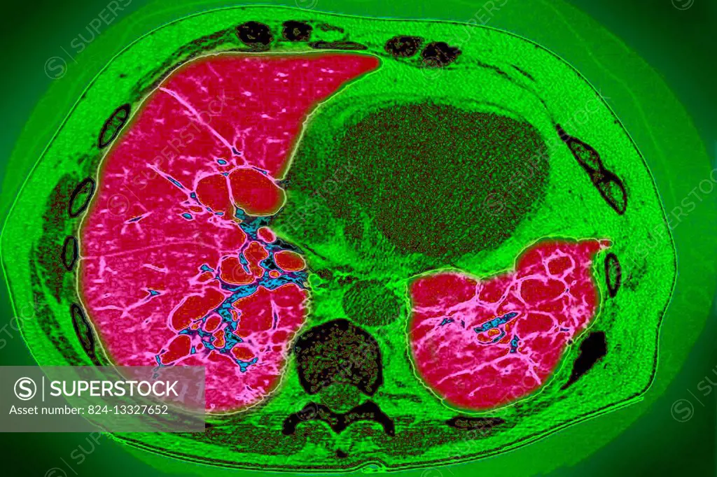 Mucoviscidosis (accumulation of mucus in the respiratory tract), seen on a radial section MRI scan.