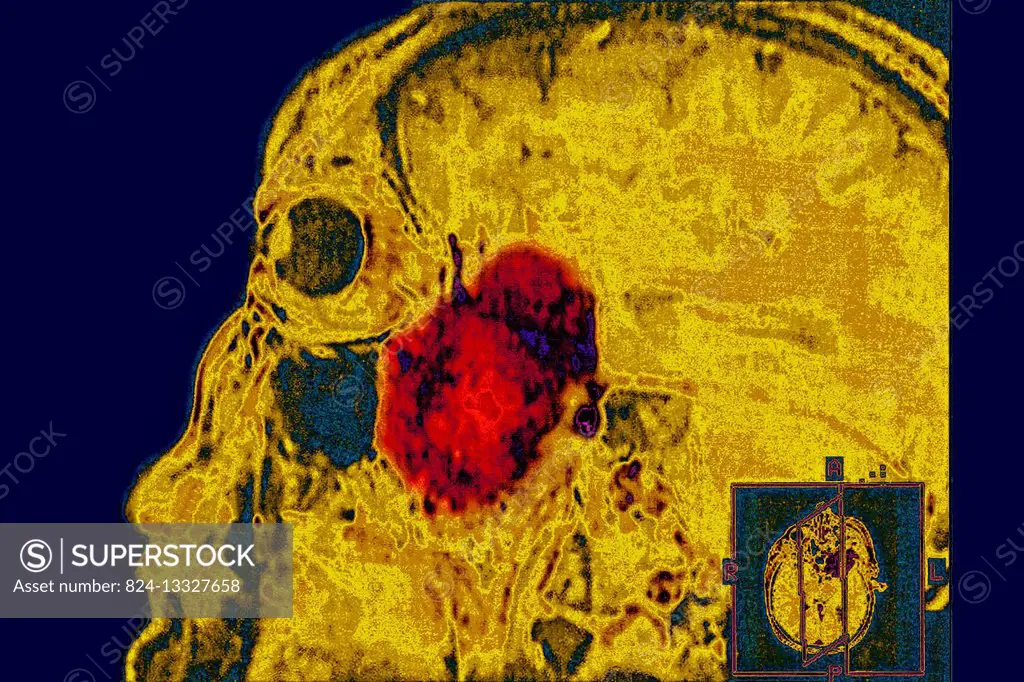 Intercranial neurinoma, seen on a sagittal section MRI scan.