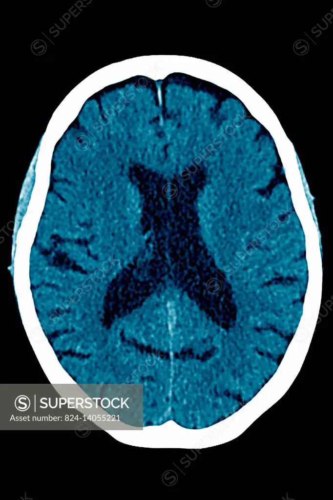 Posterior cortical atrophy (Benson£s syndrome) seen on a radial CT-scan.